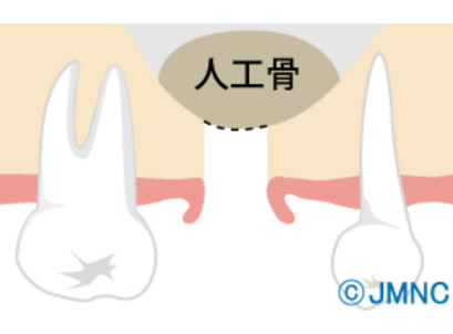 骨を補う治療