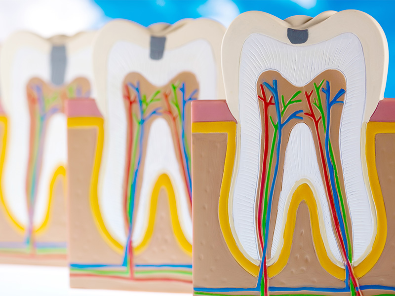 根管治療 